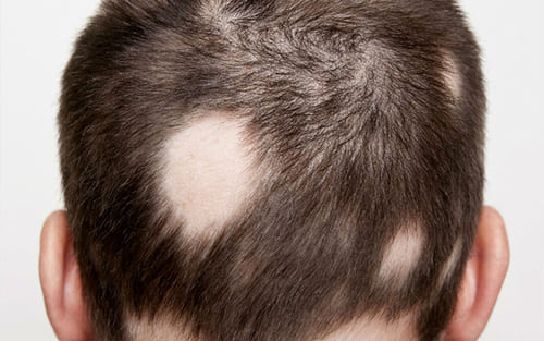 Alopesiya areata və ya ocaqlı saçtökülmə