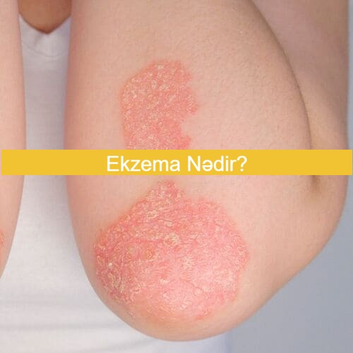 Ekzema xəstəliyinin görüntüsü