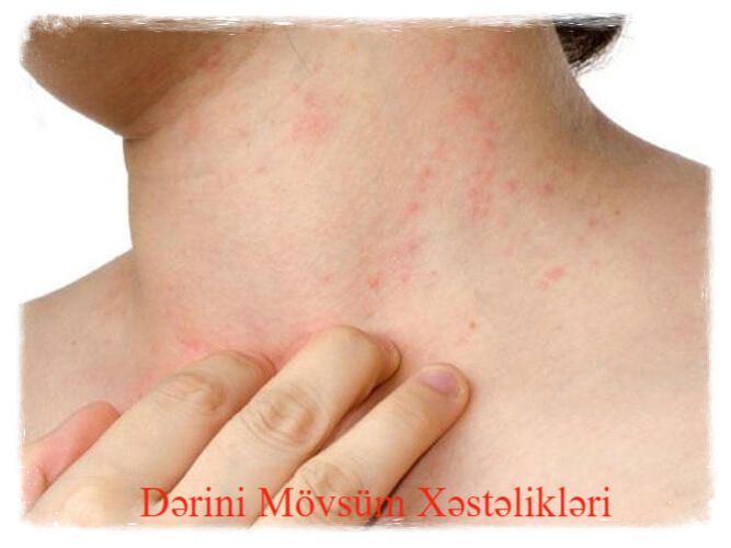 Dərinin mövsüm xəstəlikləri