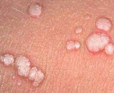 Papilloma (HPV virusu) görüntüsü