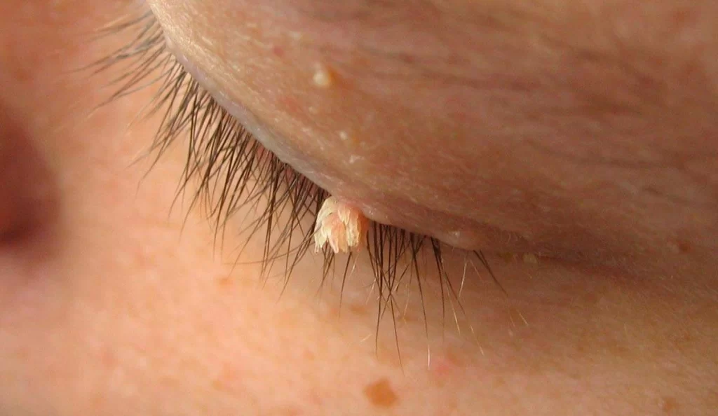 Gözdə Papilloma (HPV virusu) görüntüsü