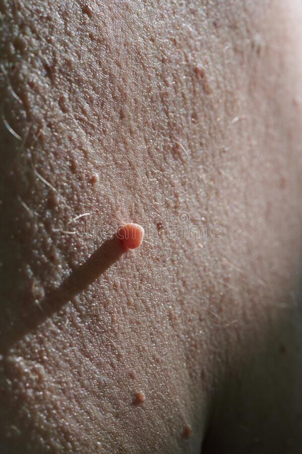 Papilloma (HPV virusu) görüntüsü