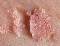 Papilloma (HPV virusu) görüntüsü
