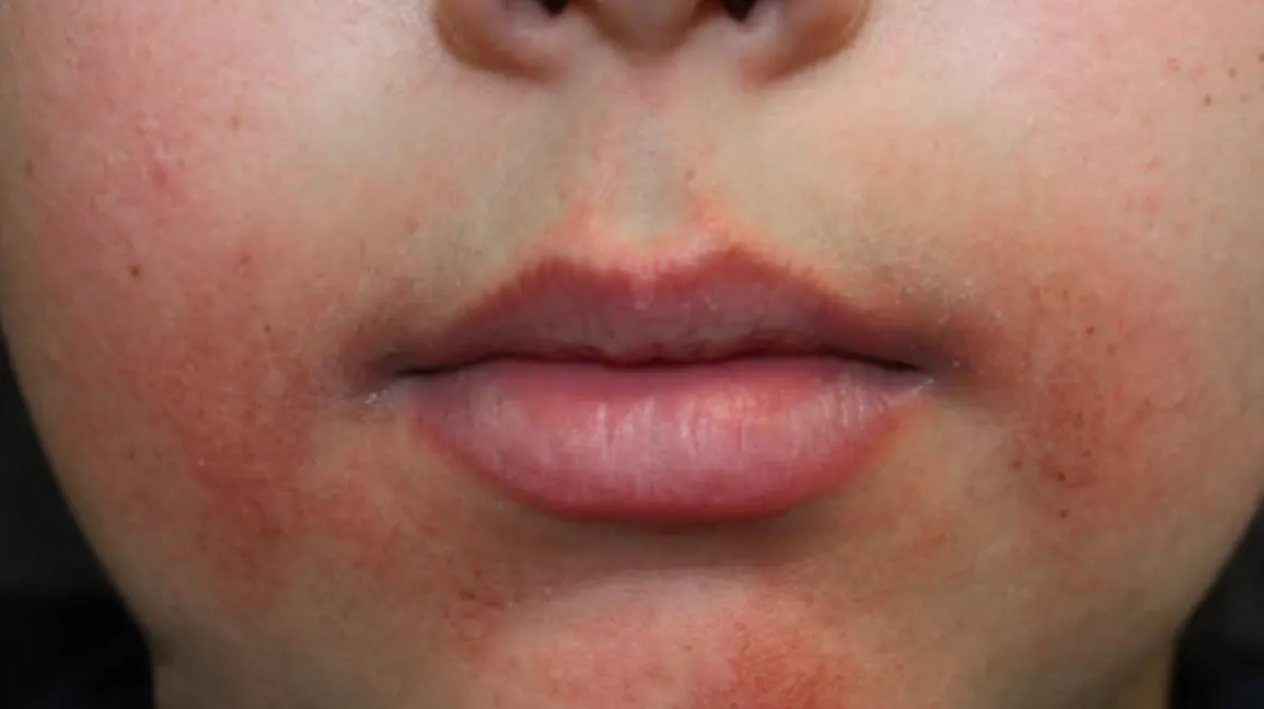 Perioral Dermatit