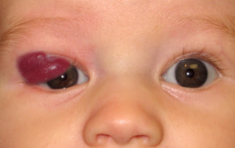 Hemangioma (Capillary Hemangioma)
