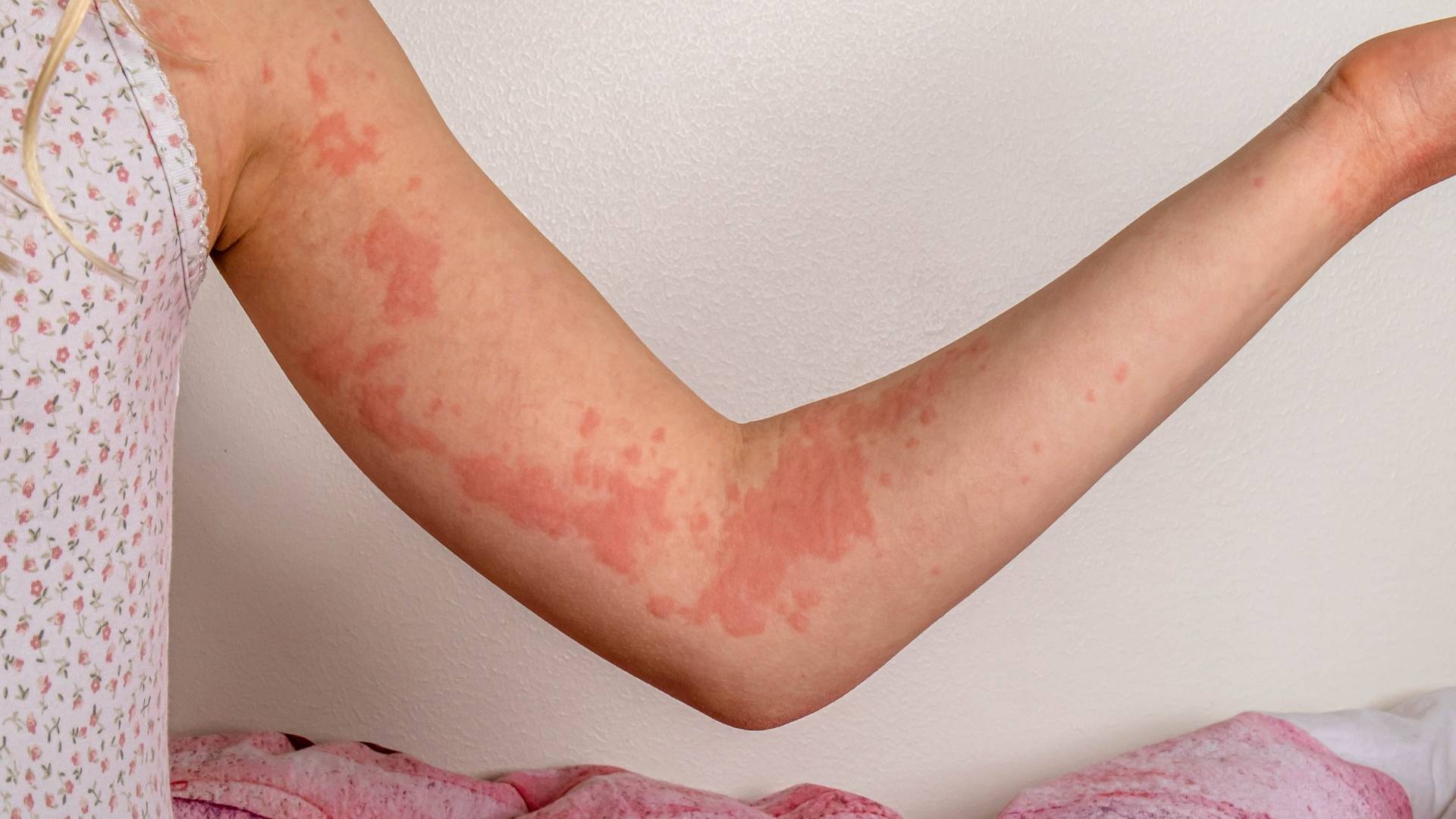 Urtikar (Övrə xəstəliyi, Urticaria)